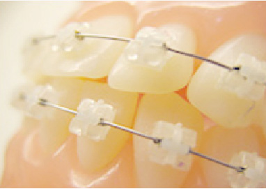 ブラケットに通すワイヤー