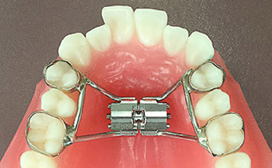 顎顔面矯正：顎の正しい成長を促す治療