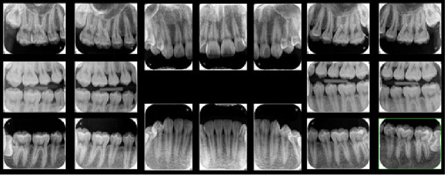 まずは歯周病検査を受けることから始めよう